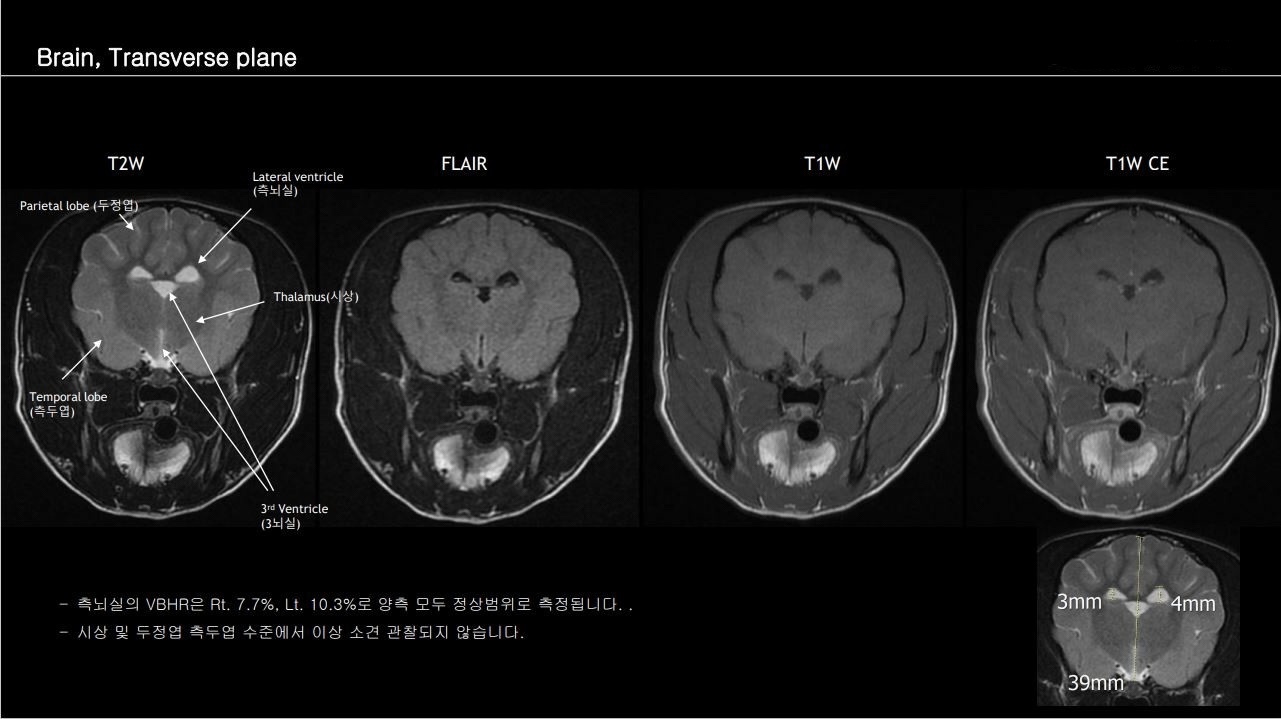 특발성 발작